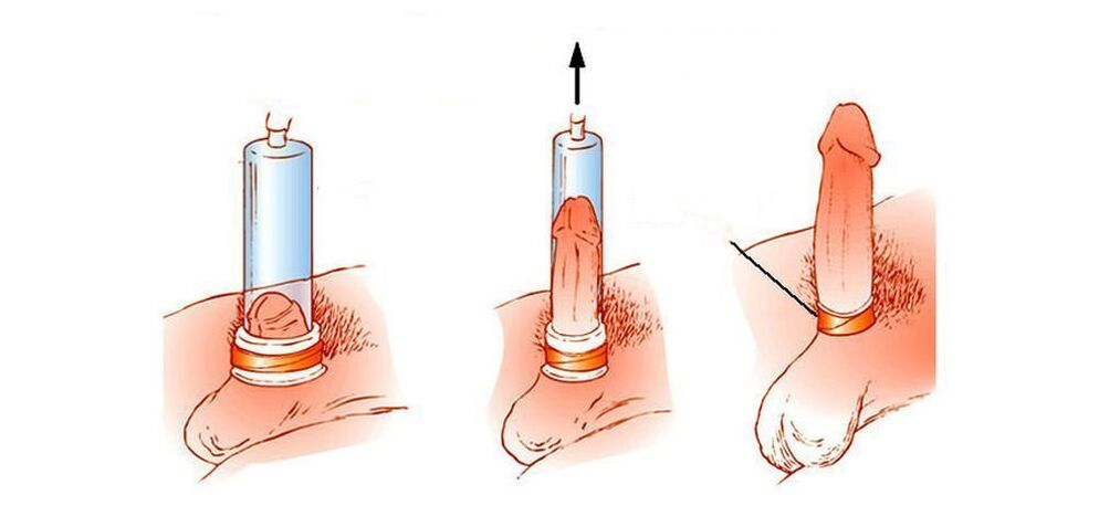 насоси вакууми penis чӣ гуна кор мекунад