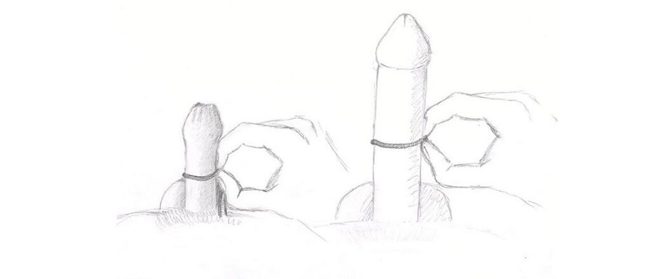 андозагирии ғафсии penis